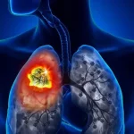 Mengenal Kanker Paru Paru Pada Bukan Perokok Panduan Lengkap Untuk Non Perokok