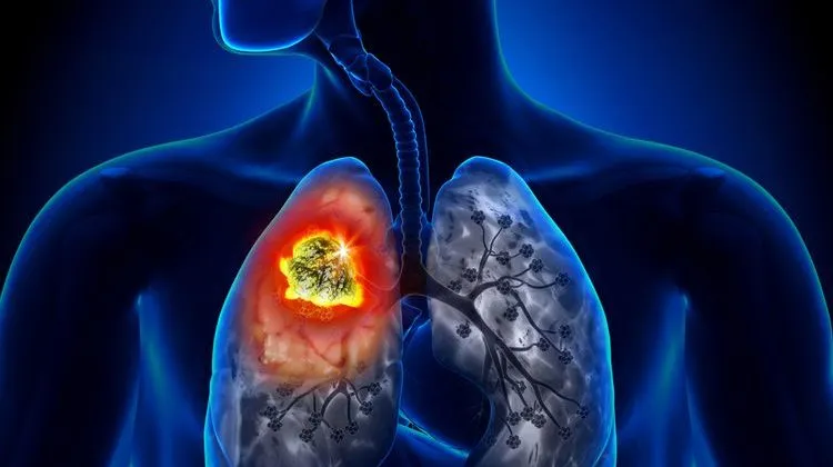 Mengenal Kanker Paru Paru Pada Bukan Perokok Panduan Lengkap Untuk Non Perokok